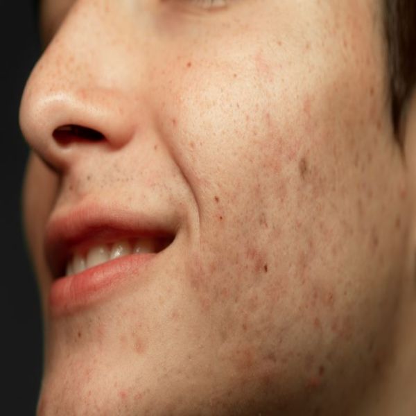 Melasma